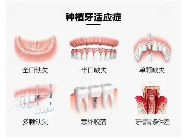 青岛维乐口腔种植牙医生