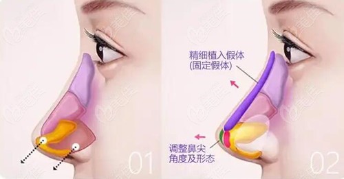 胡凯医生做鼻子口碑