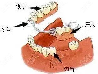 镶牙和种牙有什么区别