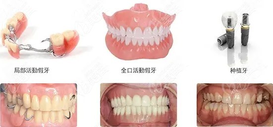 镶牙和种牙有什么区别