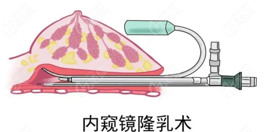 南京连天美隆胸技术：双平面内窥镜假体隆胸技术