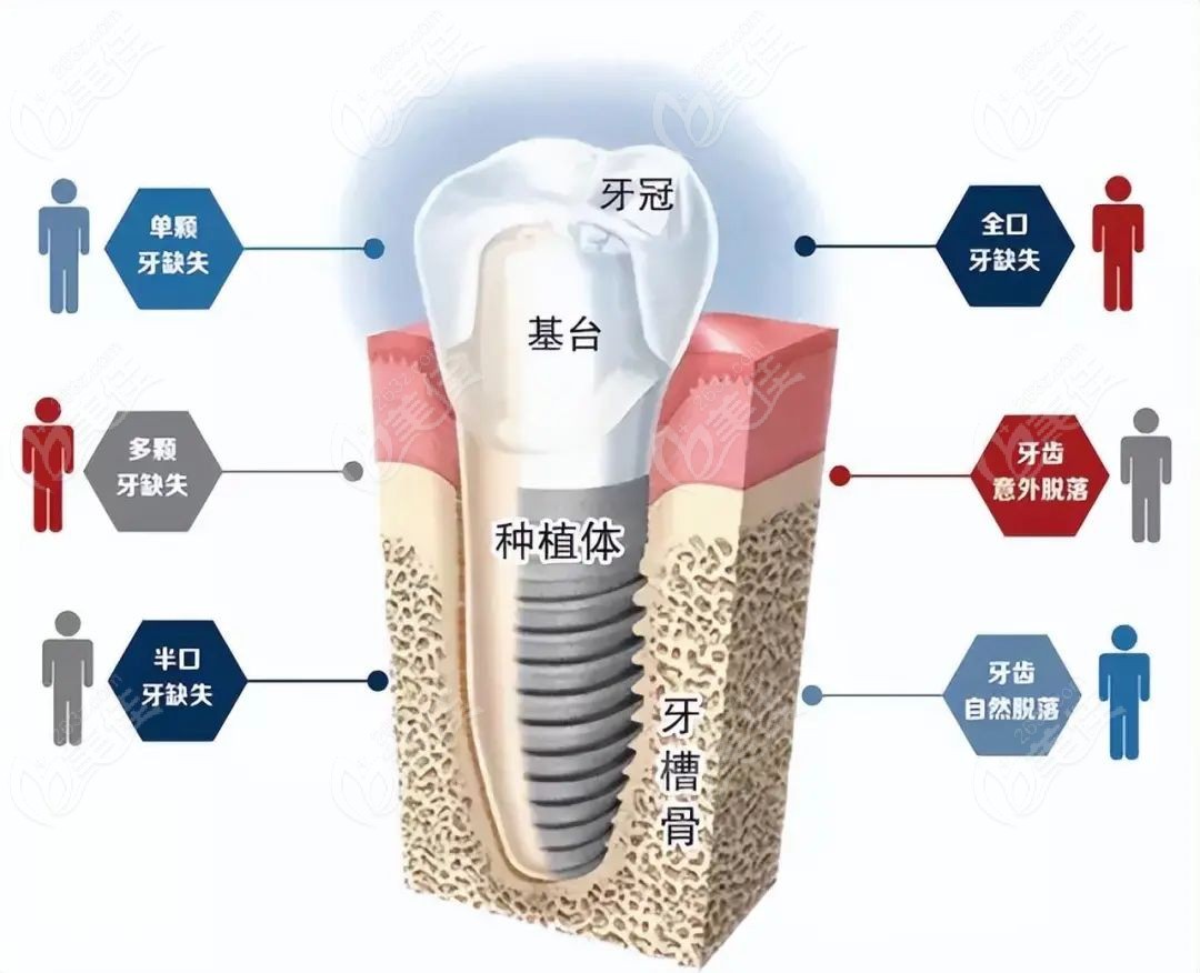 种牙后定期洗牙的作用