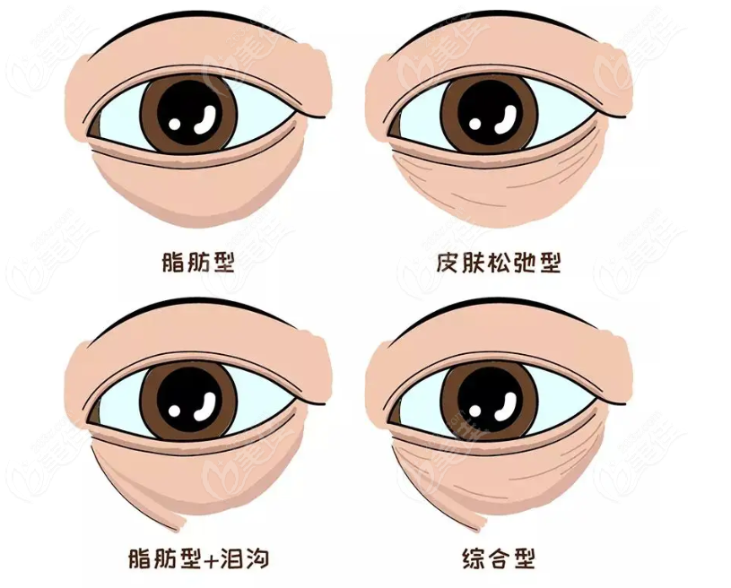 眼袋类型@236z.com