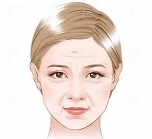 面部松弛示意圖