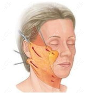 面部復位提拉怎么做原理啥