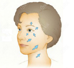 面部復位提拉手術有用哦