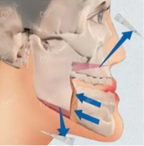 正颌手术