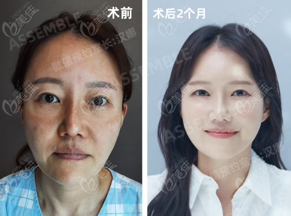韓國德麗珍整形外科醫(yī)院筋膜拉皮提升對比圖
