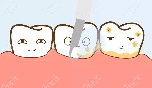 洗牙的副作用相关内容