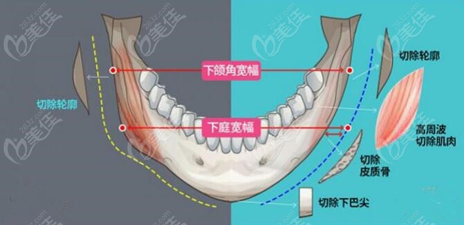 黄大勇医生改脸型适应症状