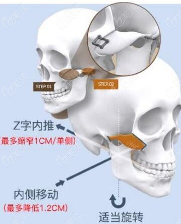 黄大勇医生颧骨内推技术特点
