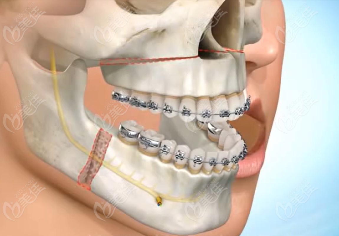 地包天正颌手术截骨图