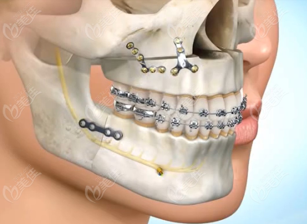 骨性地包天做正颌手术后示意图