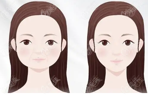 国字脸女生下颌角磨骨前后对比图@美佳网