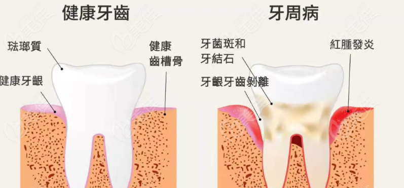 糖尿病人种植牙注意事项有哪些