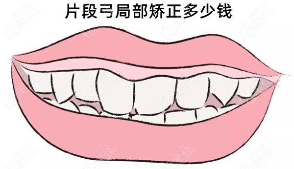 片段弓局部矫正多少钱