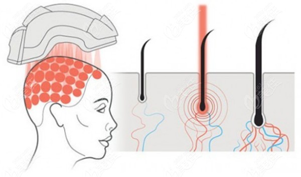植发机构的激光生发可以改善头发稀疏