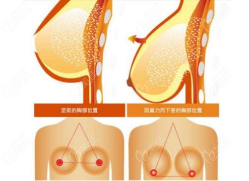 www.236z.com提供的乳房悬吊提升对比图