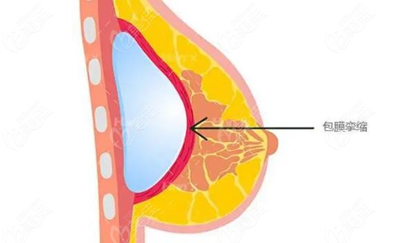 www.236z.com提供的假体隆胸包膜挛缩症状