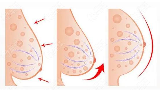 www.236z.com提供的乳房下垂提升技术图