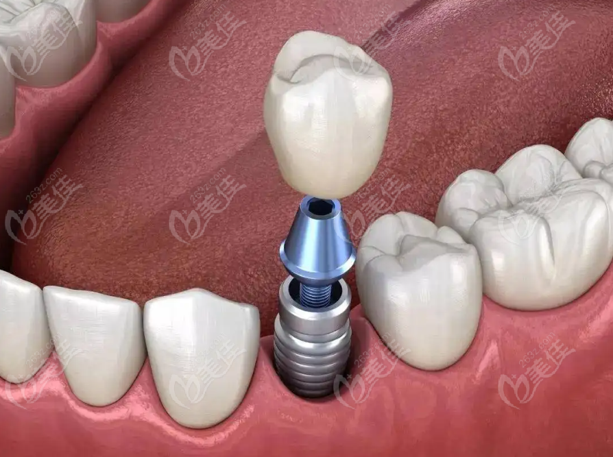 种植牙手术过程图示