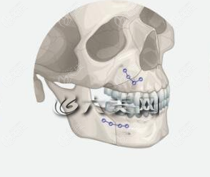 面部颌骨手术怎么做