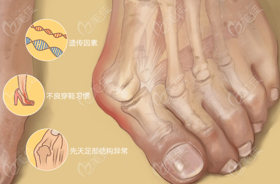 成都治疗拇指外翻费用多少钱