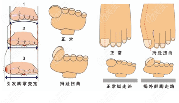 成都治疗拇外翻比较好的医院推荐