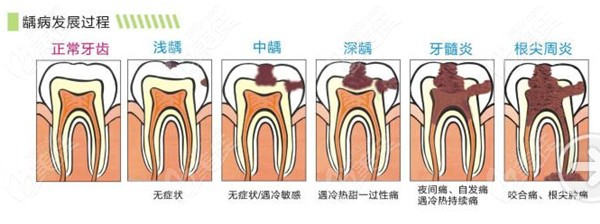 根管治疗后的牙齿裂开掉了怎么办
