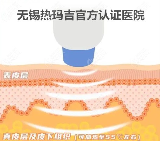 无锡热玛吉官方认证医院 无锡热玛吉官方认证医院