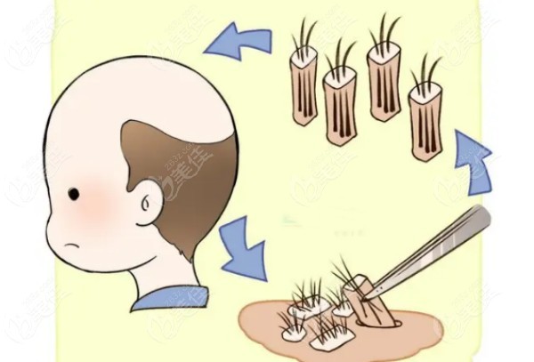 我在昆明植发的真实经历 我在昆明植发的真实经历