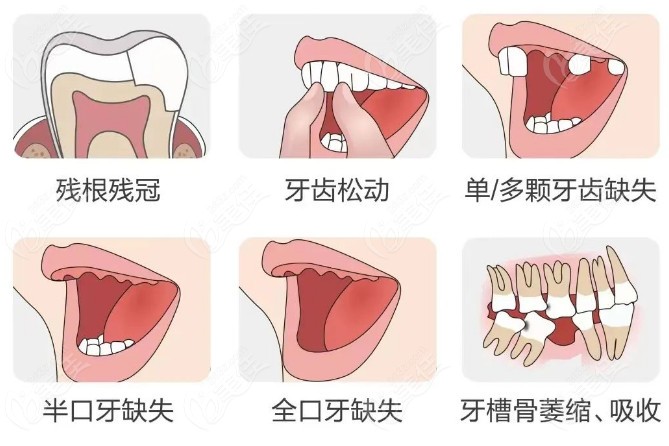 牙齿的种类和作用图片