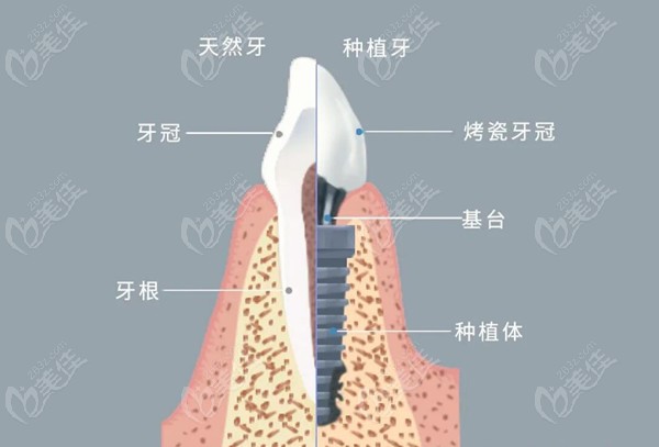 北京东城区牙科医院种植牙价格表