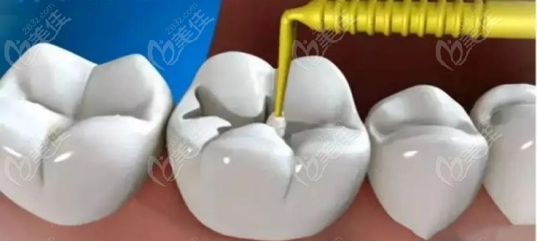 补牙手术操作图236z.com