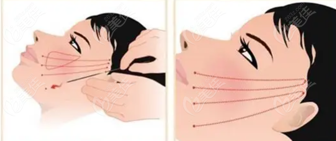 面部埋線提升除皺