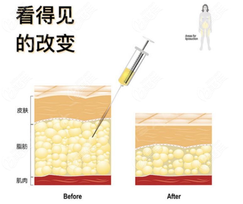 冯斌吸脂技术特色