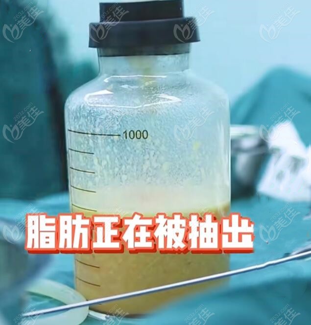 冯斌抽脂和普通抽脂的区别分析