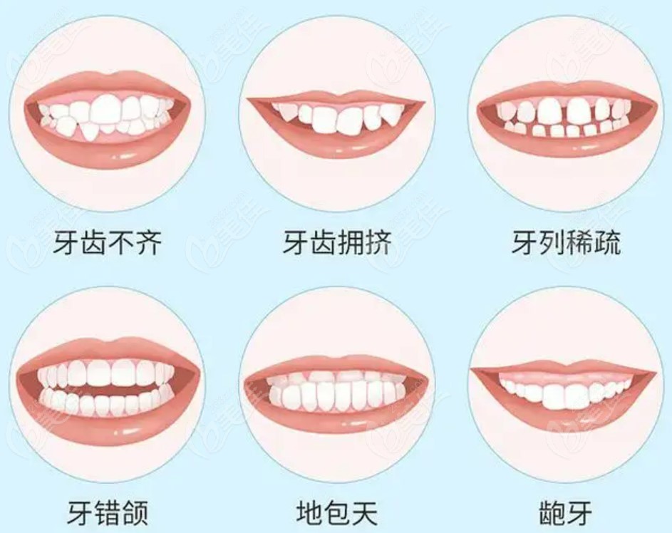 牙齿矫正多少钱价格表2022