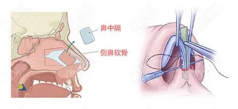 www.236z.com提供的鼻尖下降修复图