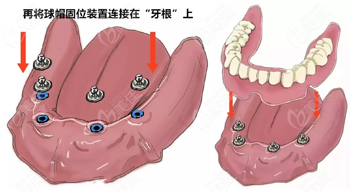 球帽半固定种植牙图片