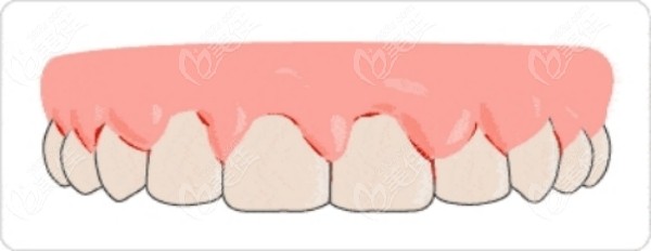 缺牙可能导致牙龈萎缩