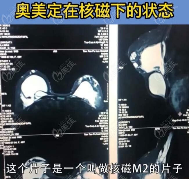 面部和胸部注射物奧美定在核磁共振下圖片