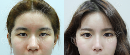 韩国faceplus做双眼皮怎么样？从单结双重埋线双眼皮结果图参考