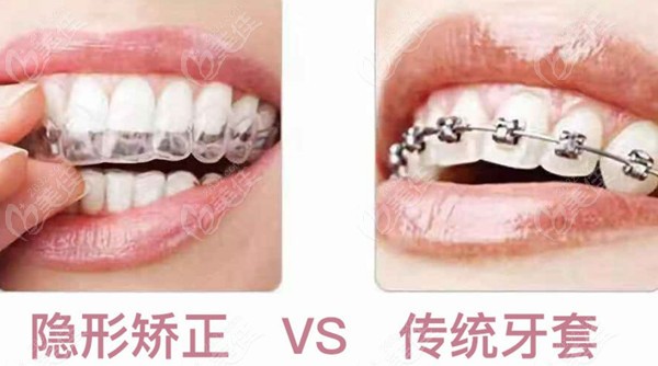 石景山区金属固定托槽牙齿矫正价格