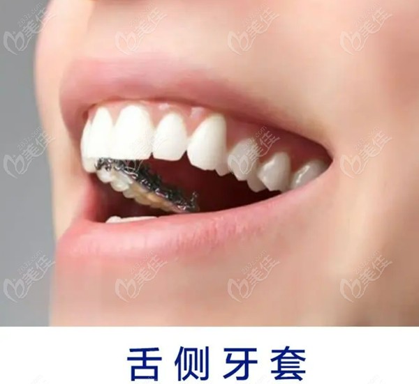 北京石景山区舌侧隐形牙齿矫正价格