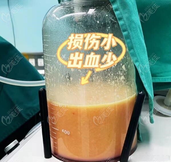冯斌抽脂损伤小