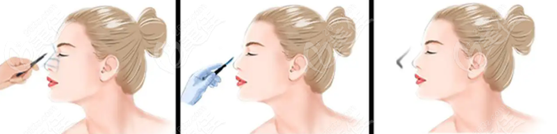 鼻修复手术前设计方案