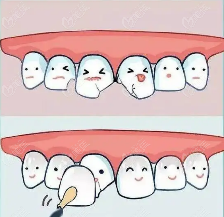 前牙装6颗全瓷牙的感受