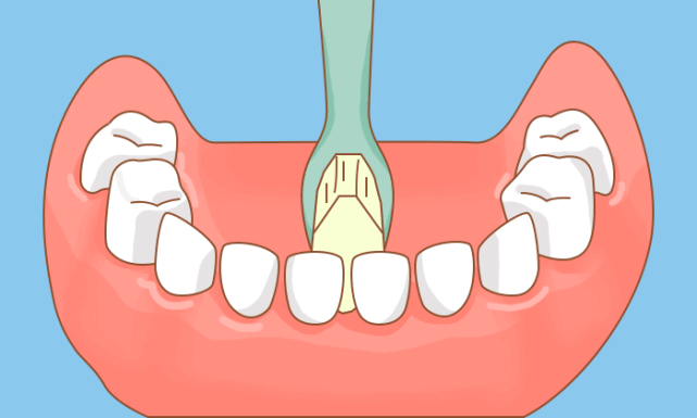 前牙装6颗全瓷牙的感受
