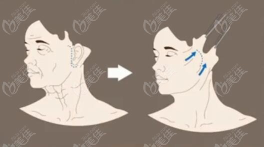 脖子拉皮手術有危險嗎